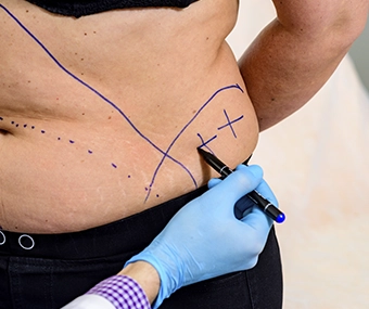 Abdominoplastía