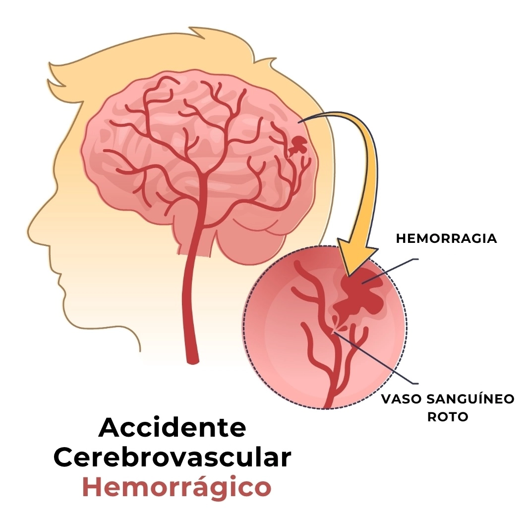 Ilustración de un accidente cerebrovascular hemorrágico