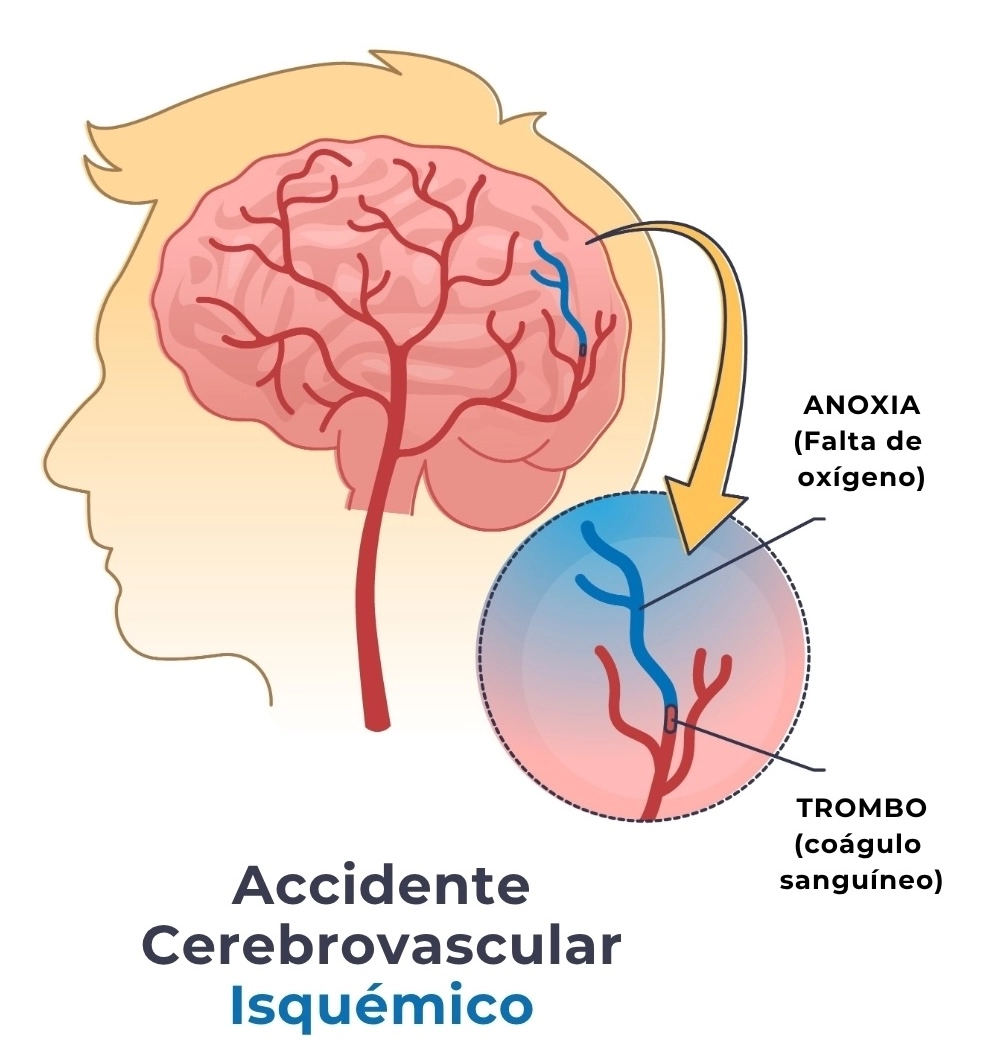 Ilustración de un accidente cerebrovascular isquémico