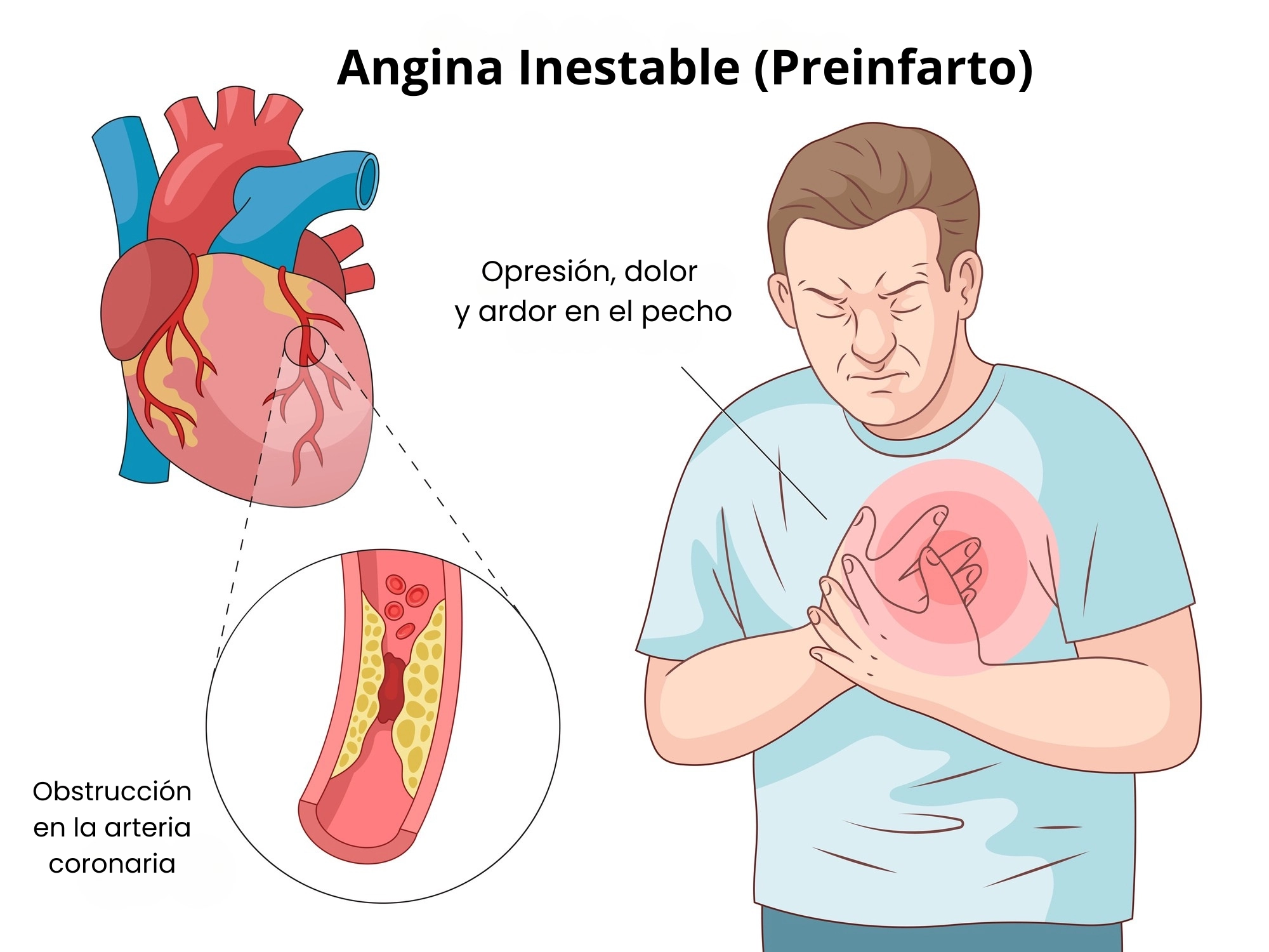 infografía de síntomas de preinfarto