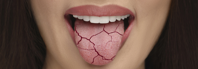 boca seca xerostomía