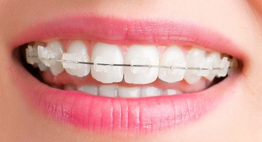 persona con brackets transparentes