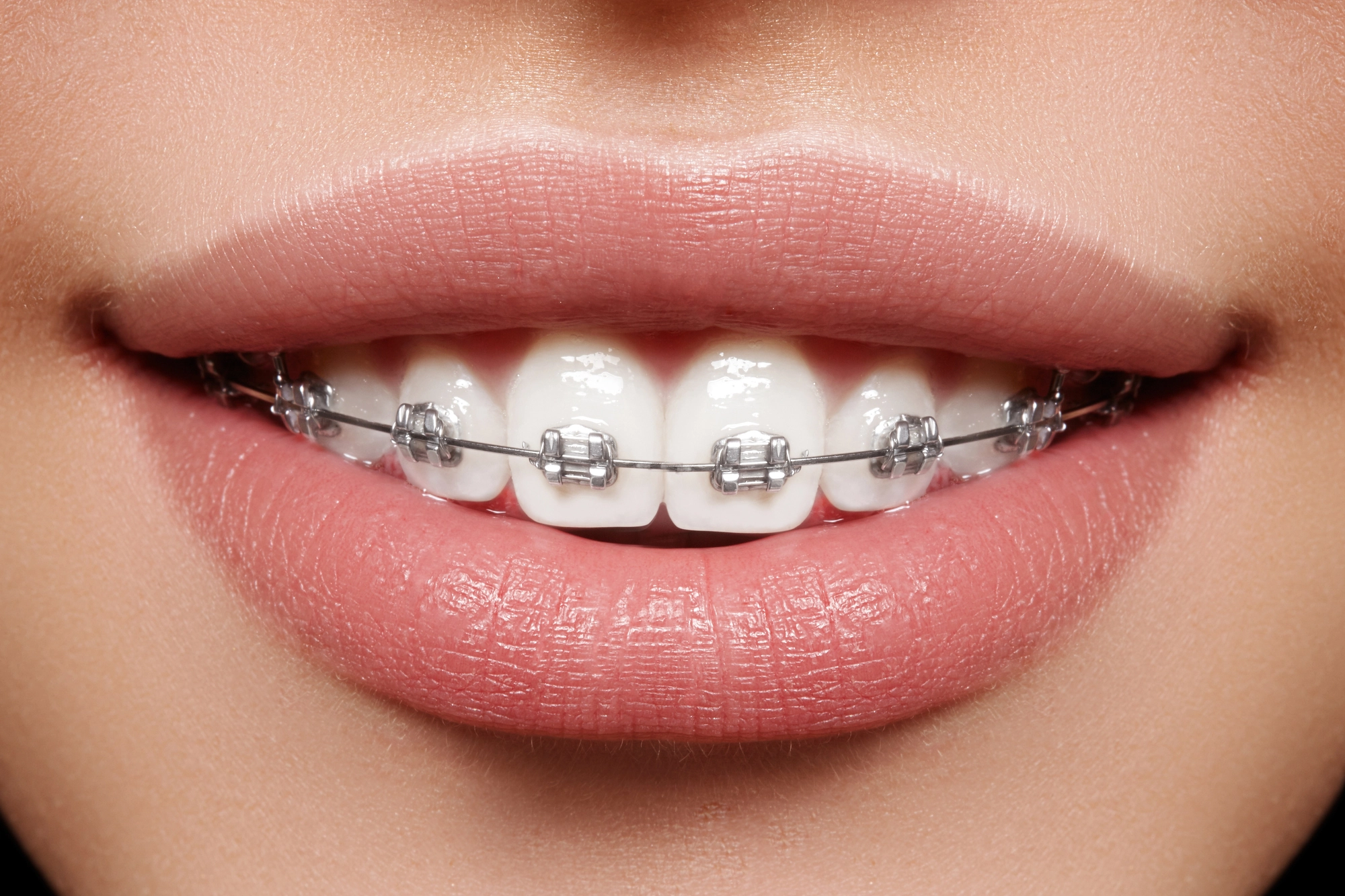 persona con brackets metálicos