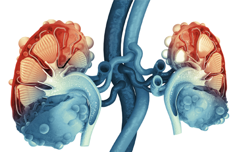 cancer renal