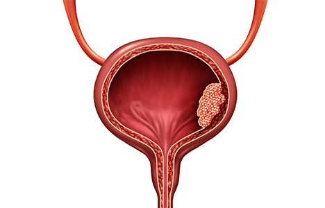 cancer renal