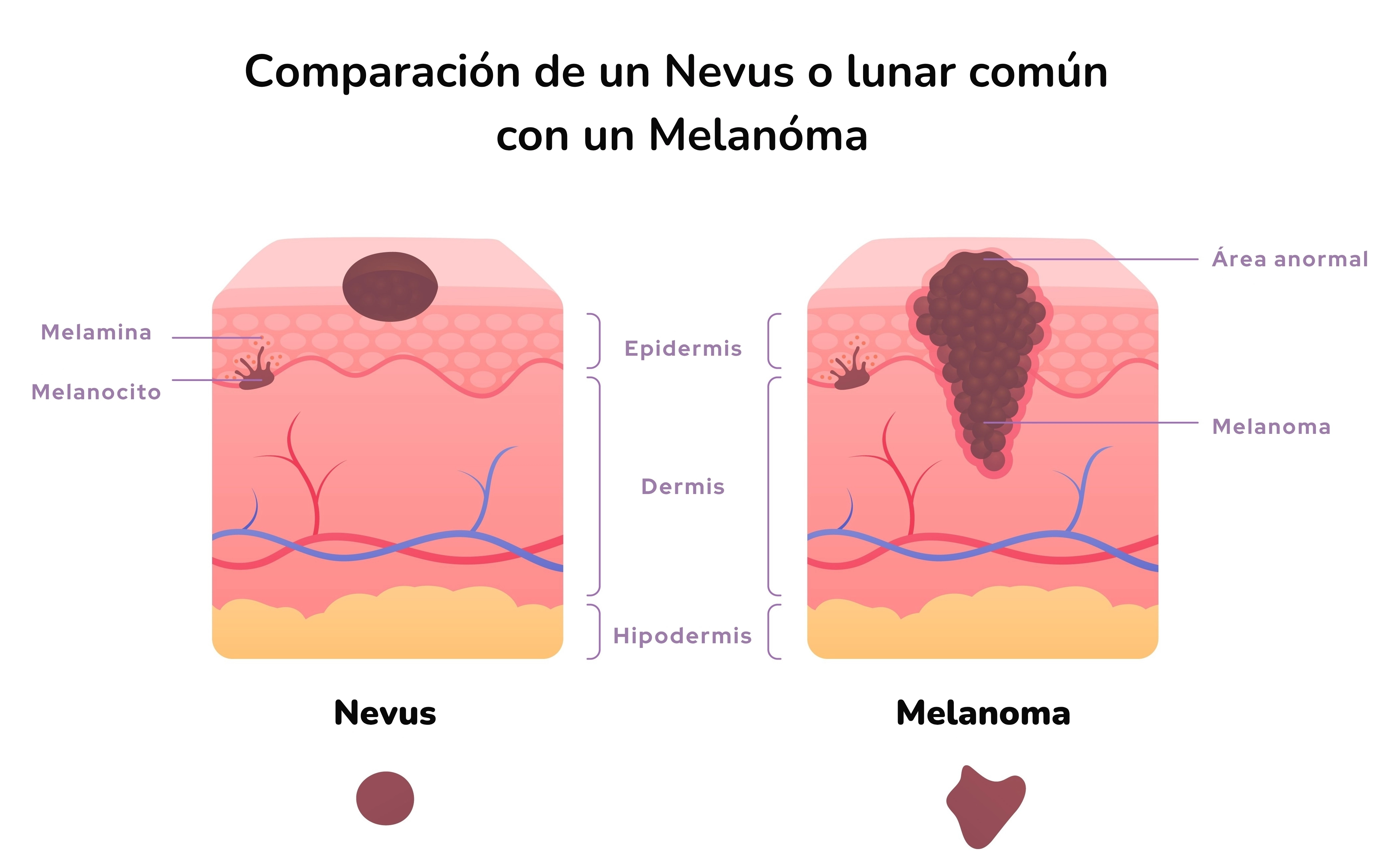 ilustración que compara un lunar o nevus con un melanóma