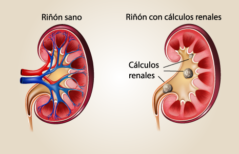 ilustración médica acerca de cálculos renales