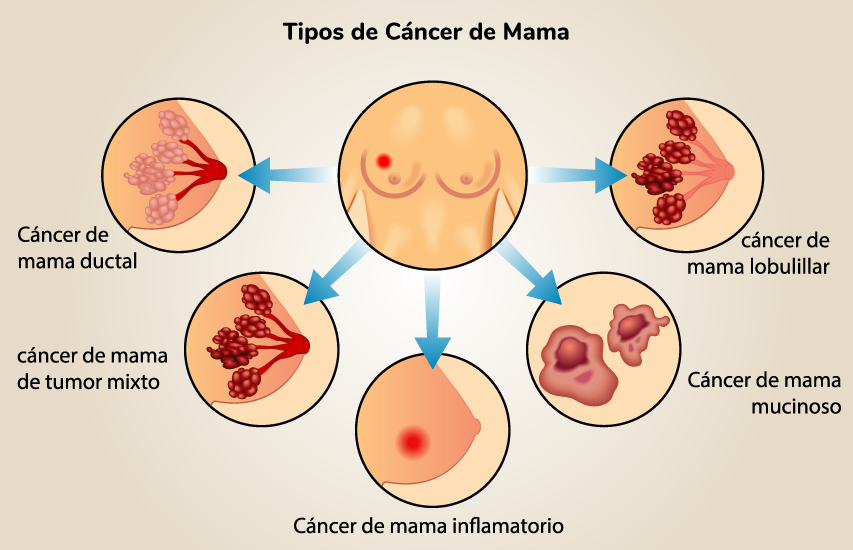 Cáncer de Mama Cáncer de Mama