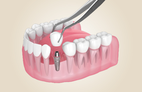Implantes Dentales