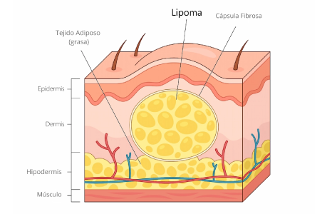Lipoma