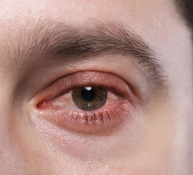 persona con conjuntivitis