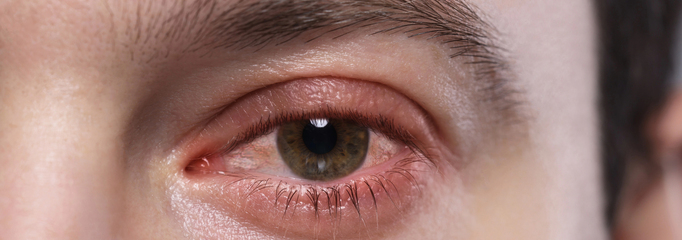 persona con conjuntivitis