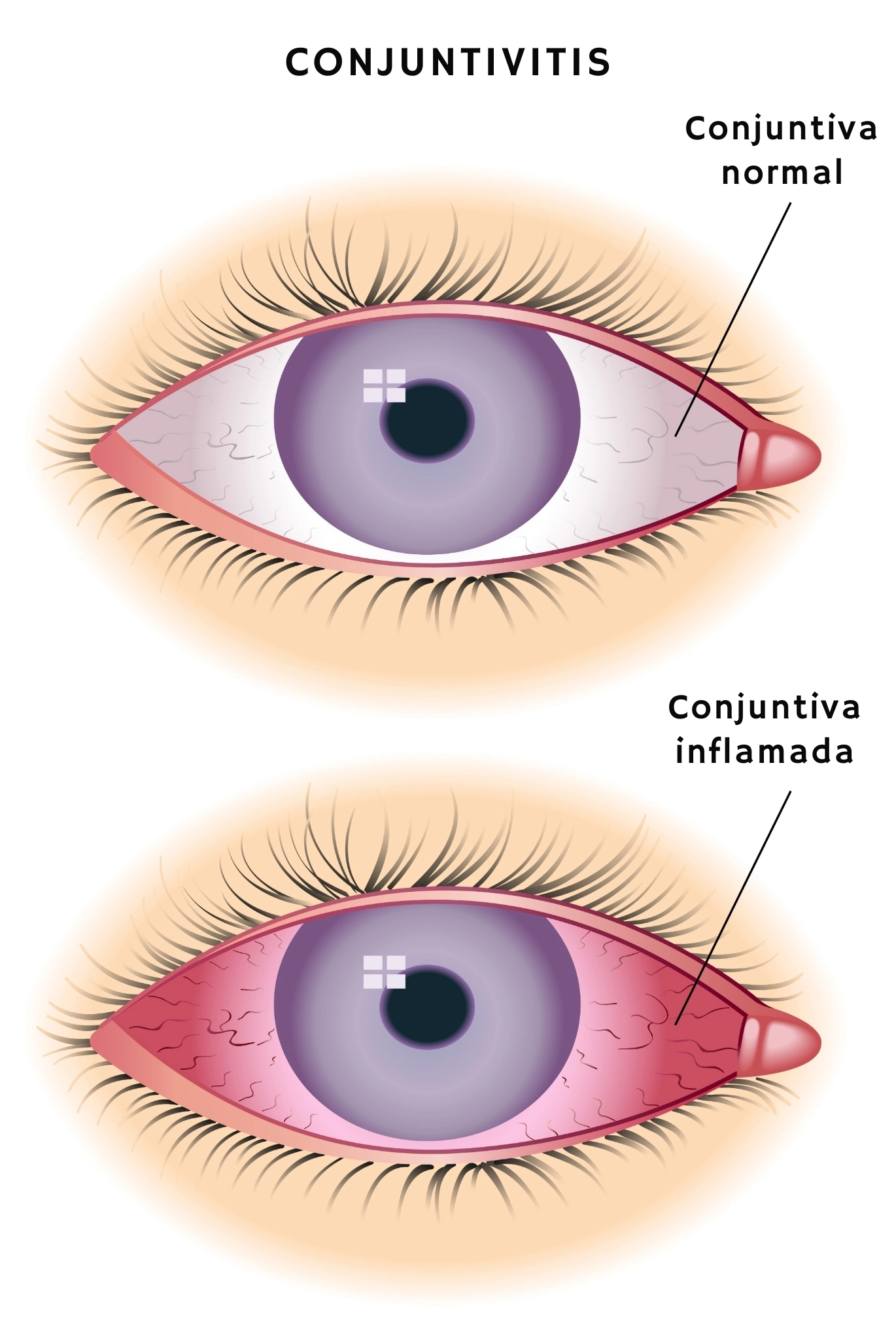 ilutración que muestra cómo se manifiesta la conjuntivitis en los ojos
