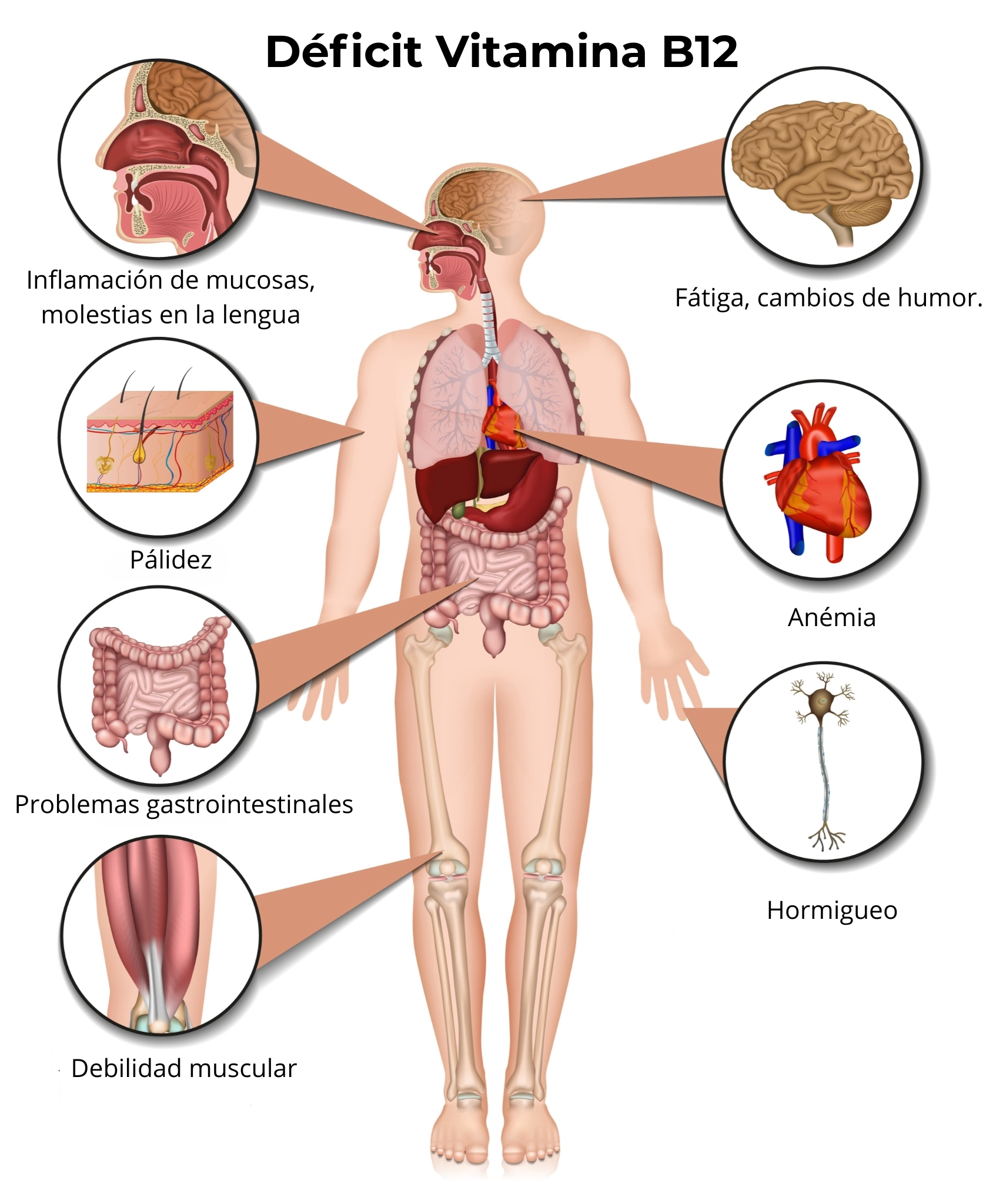 déficit de vitamina b12