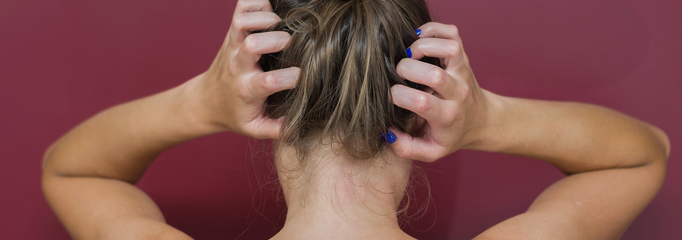 persona con dermatitis seborreica en el cuero cabelludo