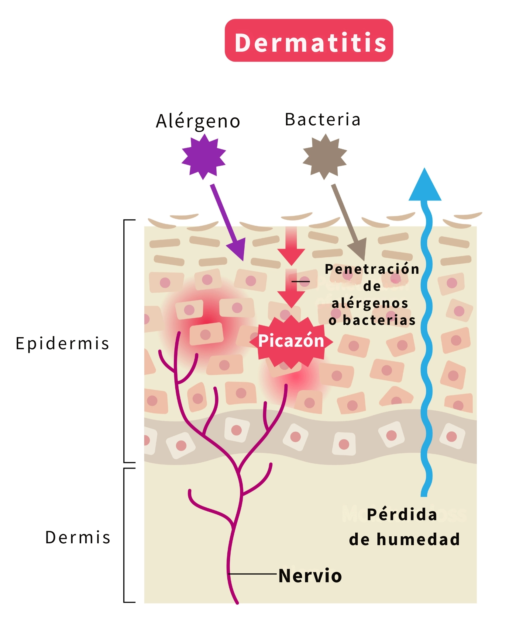 ilustración que explica cómo se produce la dermatitis atópica
