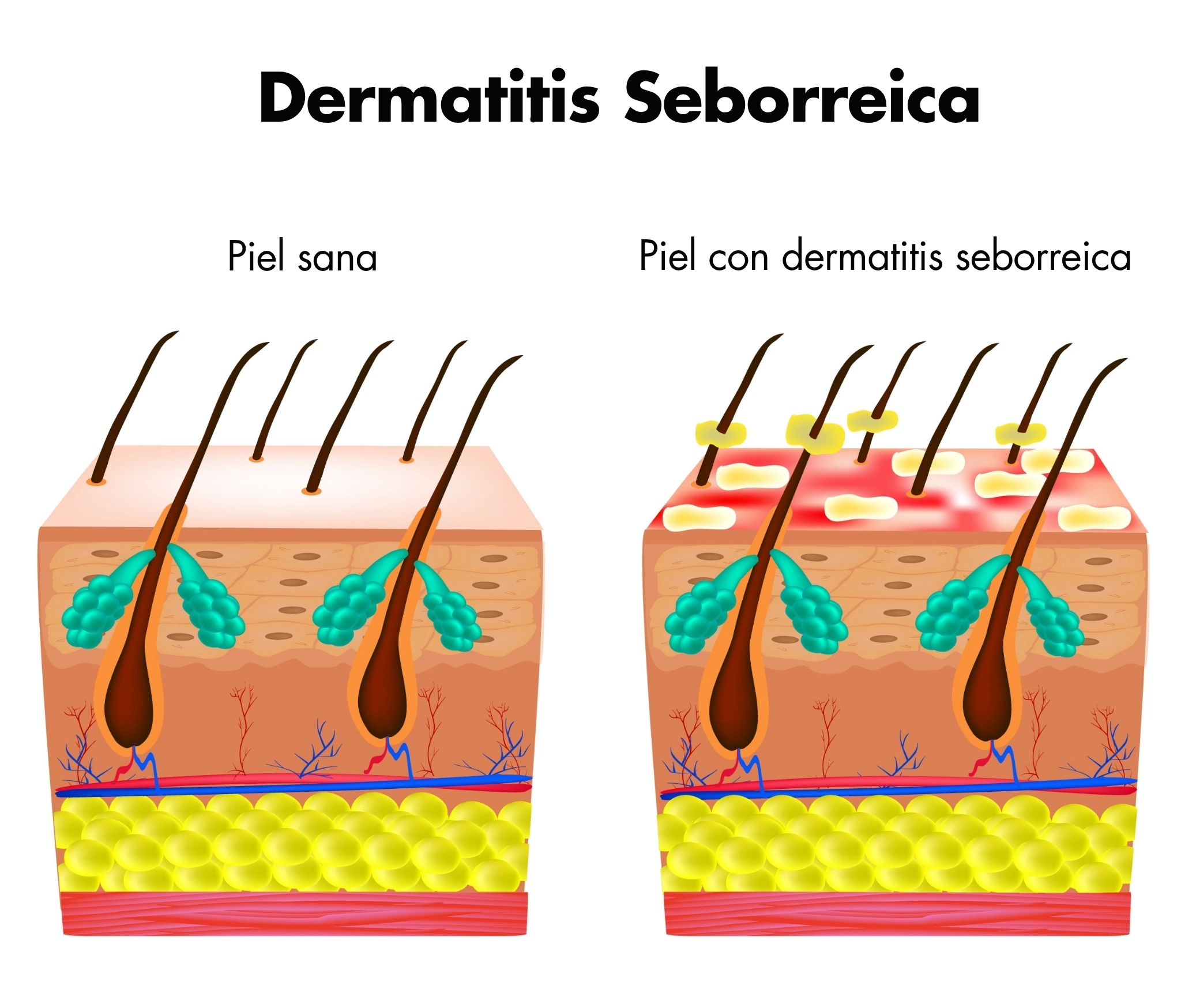 ilustración de la dermatitis seborreica