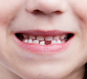 dientes de leche