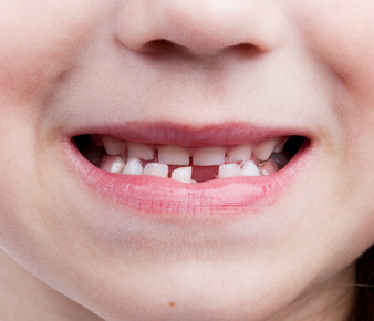 dientes de leche