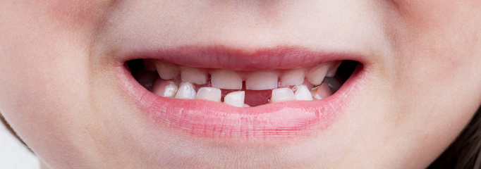 dientes de leche