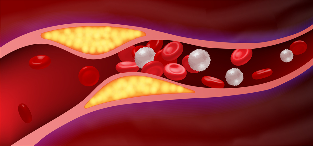 dislipidemia imagen ilustrativa de colesterol en la sangre
