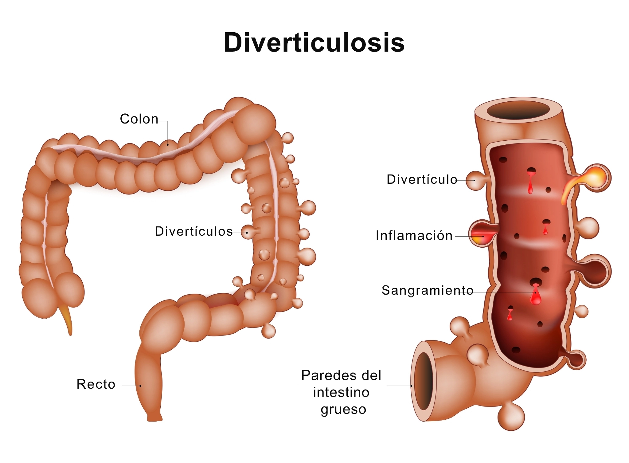 ilustración médica de la diverticulosis de colon
