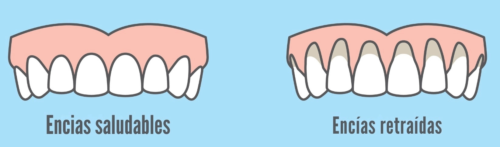Ilustración encías saludables y encías retraídas