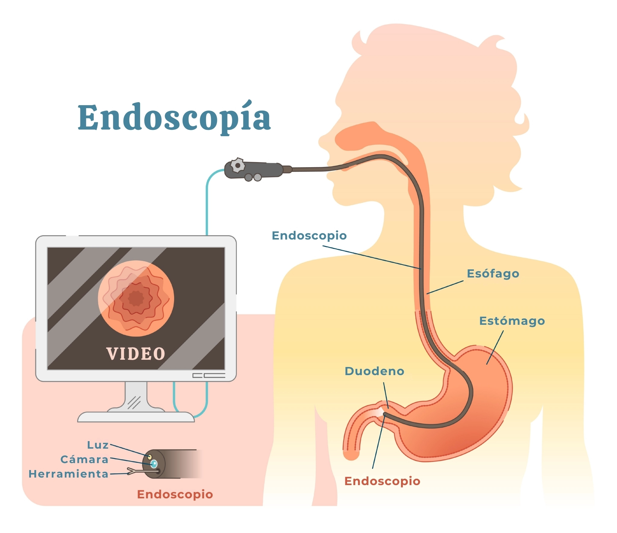 illustración explicativa de una endoscopía