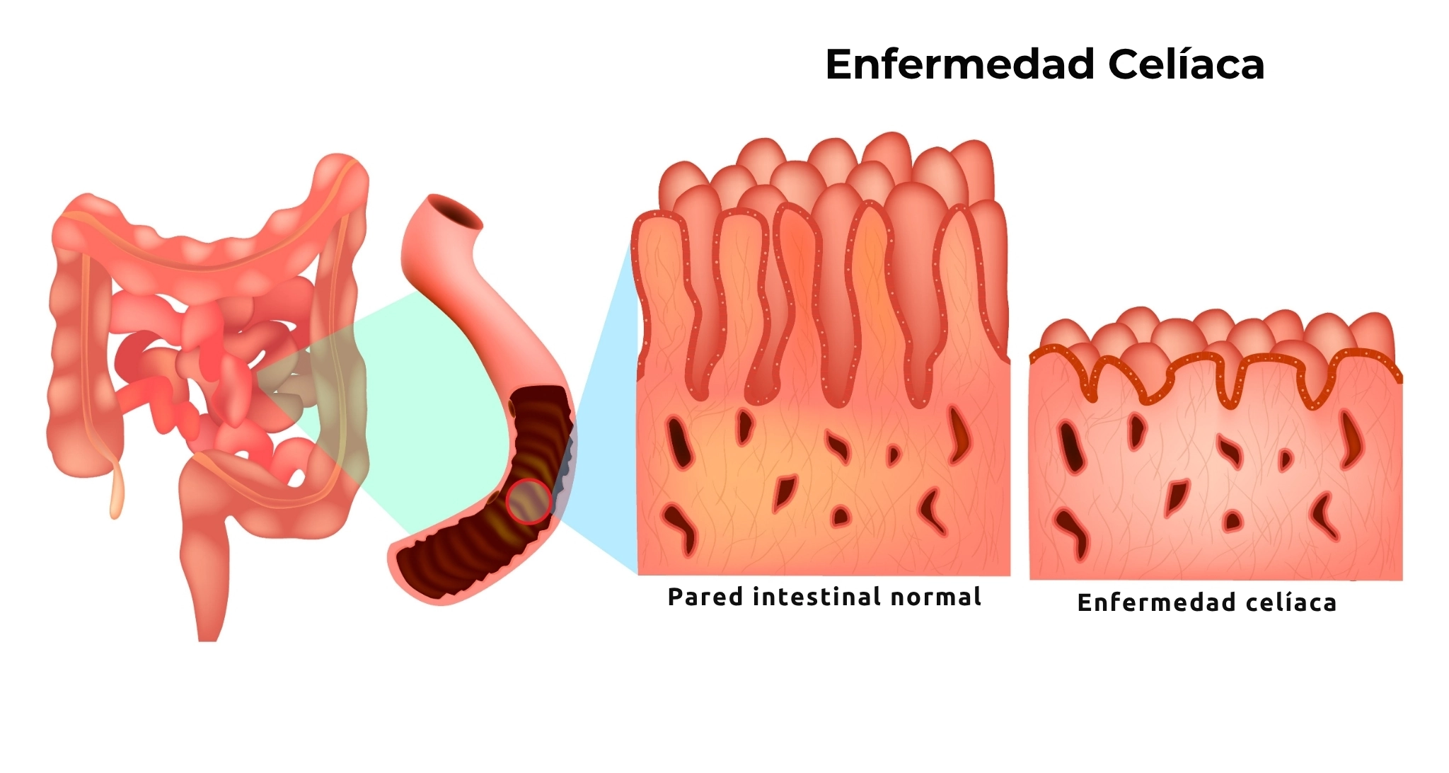 ilustración enfermedad celíaca