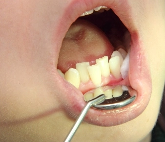 enfermedad dental RedSalud