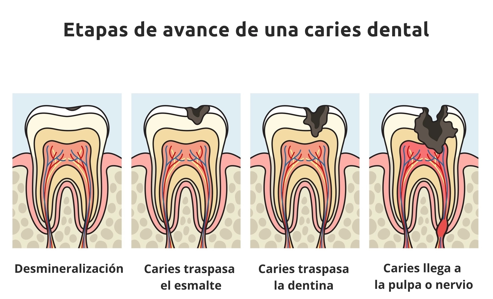 ilustración que muestra el avance de la caries dental si no se trata