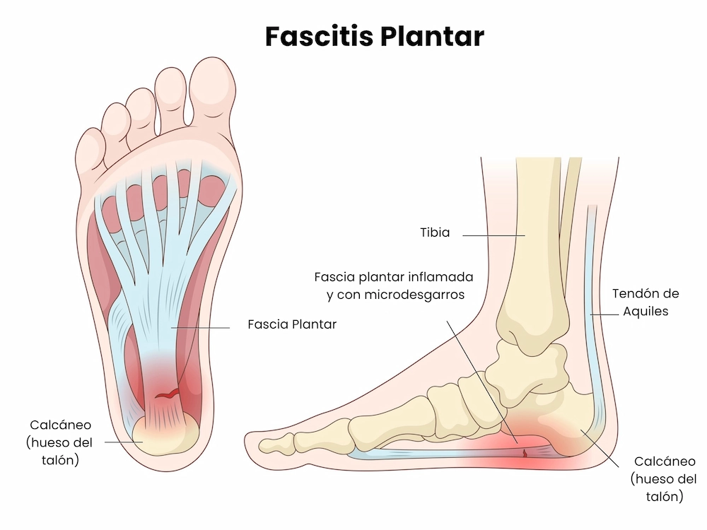Fascitis plantar