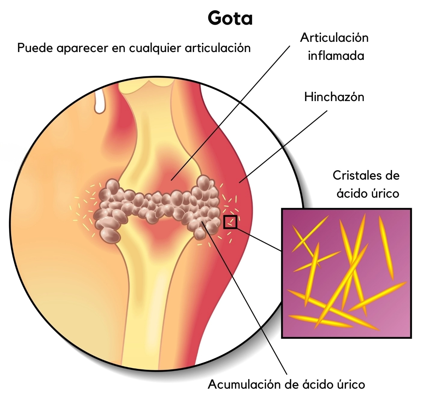 ilustración que muestra cómo la acumulación de ácido úrico provoca la gota