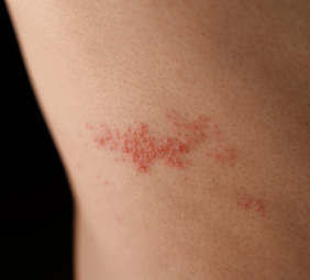 persona con herpes zoster en el torso