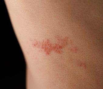 persona con herpes zoster en el torso