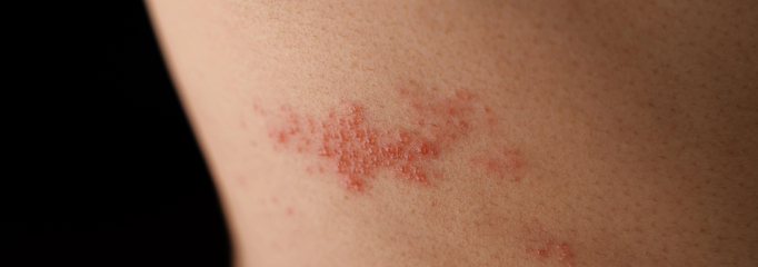 persona con herpes zoster en el torso