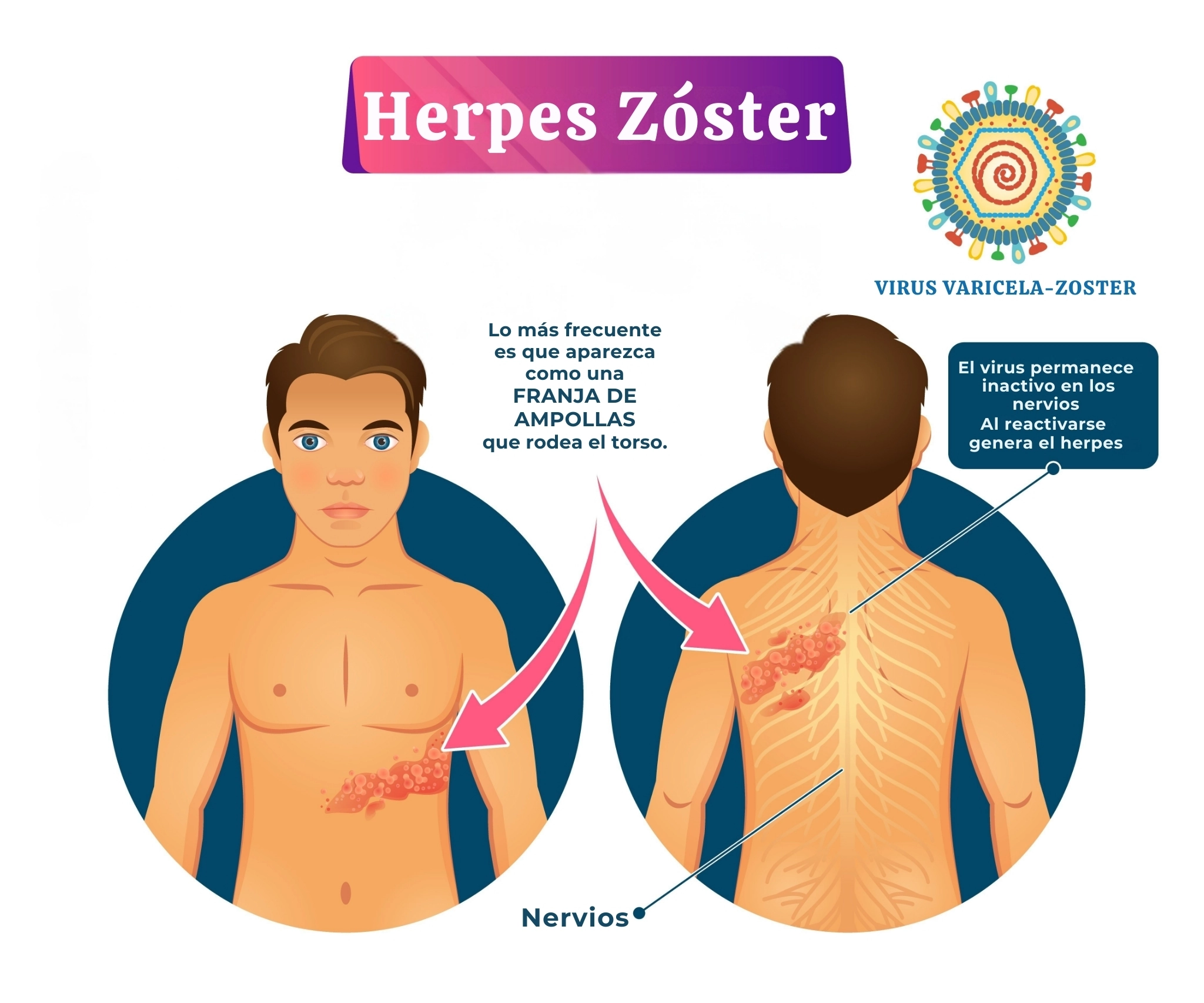 ilustración acerca del herpes zoster