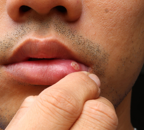 persona con afta en el labio