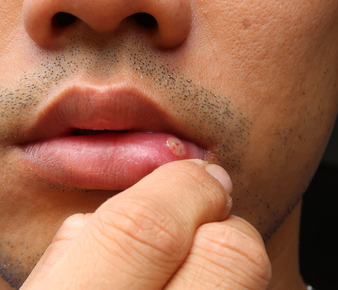 persona con afta en el labio