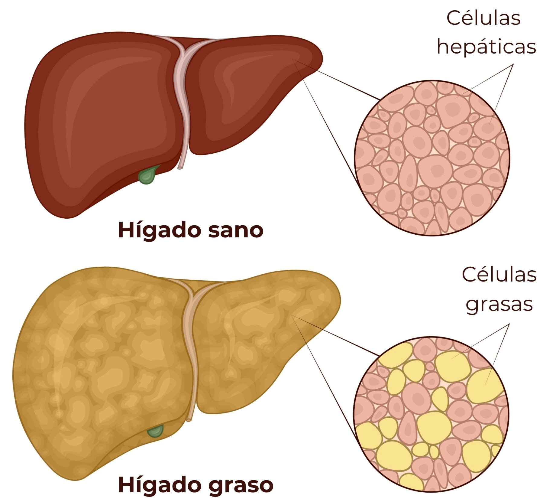 ilustración hígado graso