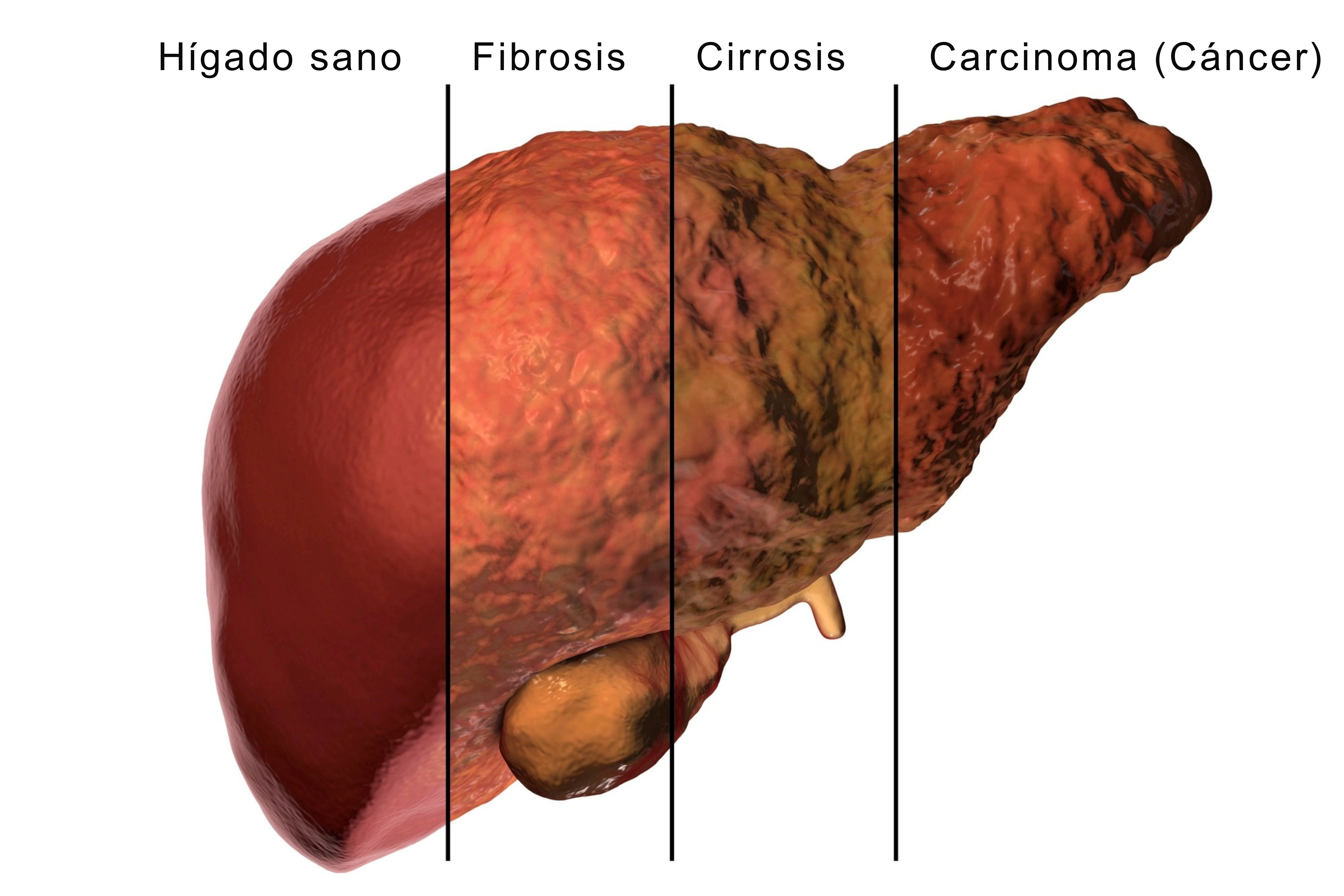 Evolución del daño hepático por hepatitis C