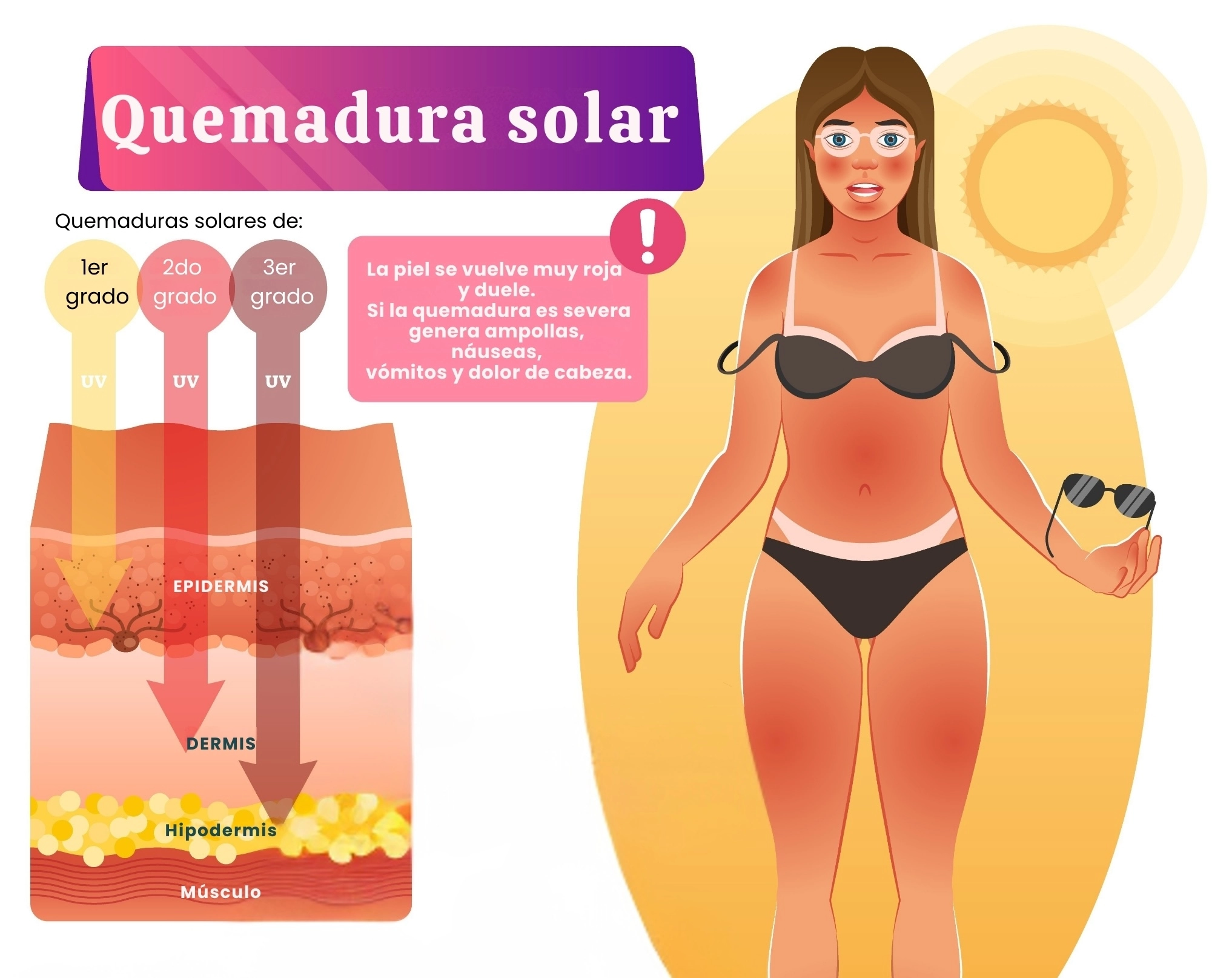 ilustración explicativa de una quemadura solar