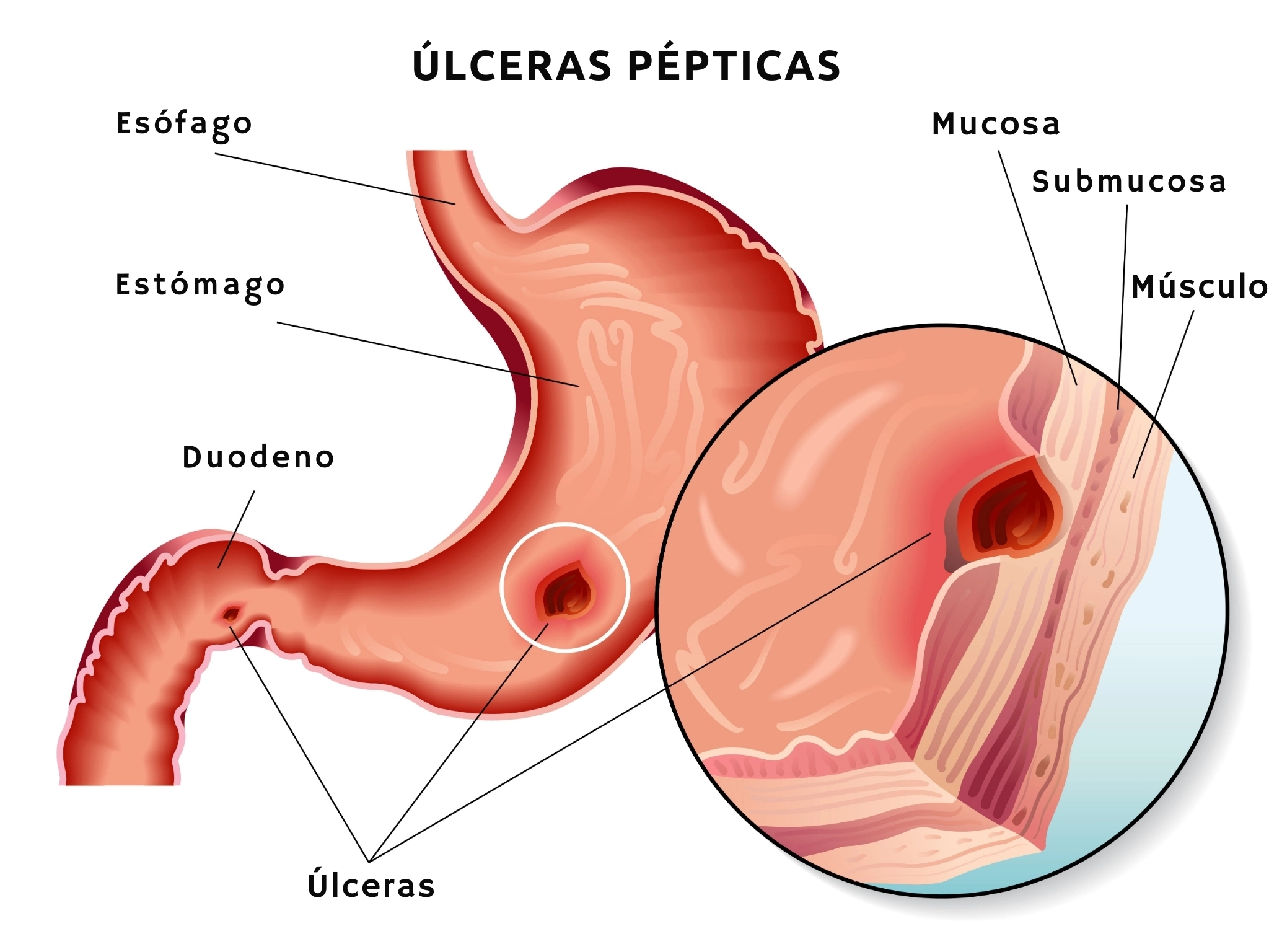 ilustración úlceras pépticas: gastricas y duodenales