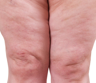 Lipedema