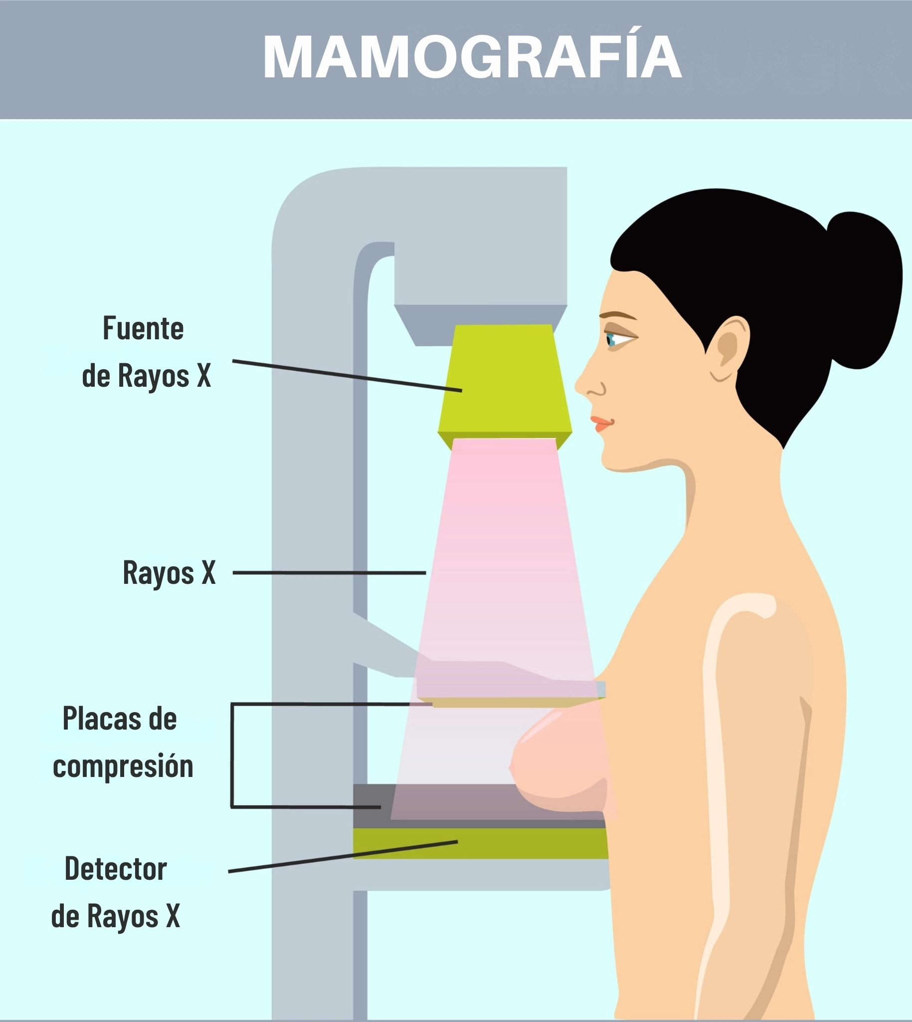 ilustración que muestra cómo se hace el exámen de mamografía