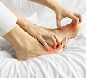 persona con micosis u hongos en los pies