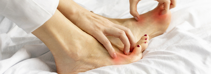 persona con micosis u hongos en los pies