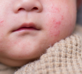 bebé con miliaria
