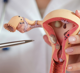  Mioma uterino