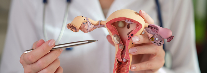  Mioma uterino